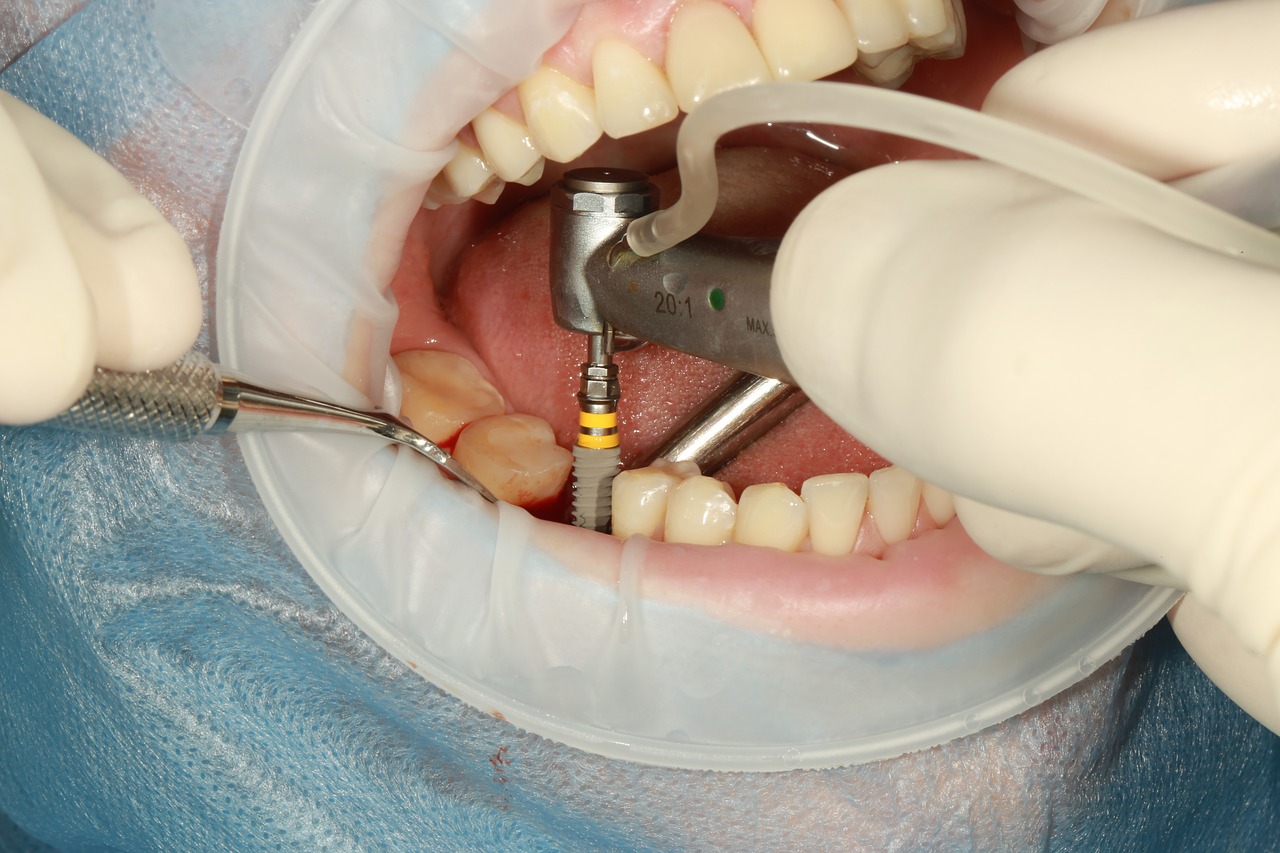 Dental PRP by Med Solutions